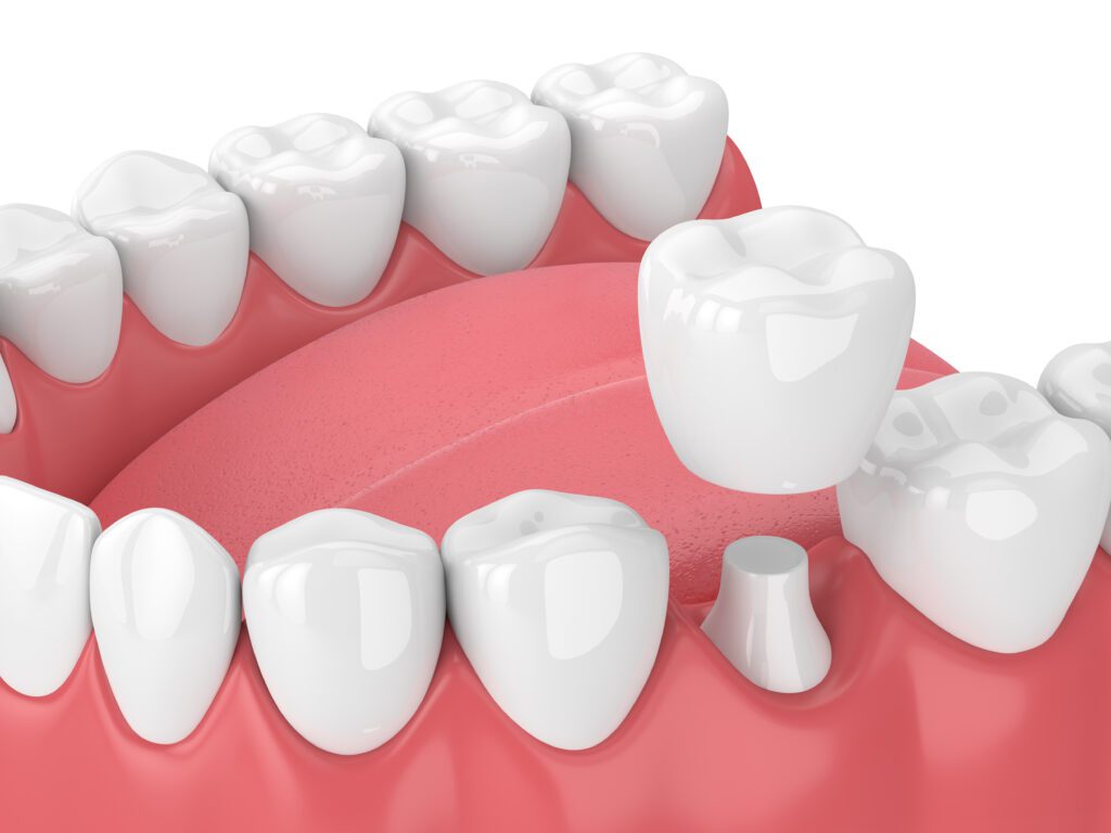 dental crowns same-day crowns Snellville