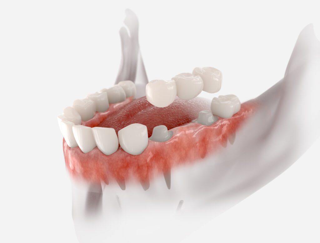 dental bridge Snellville