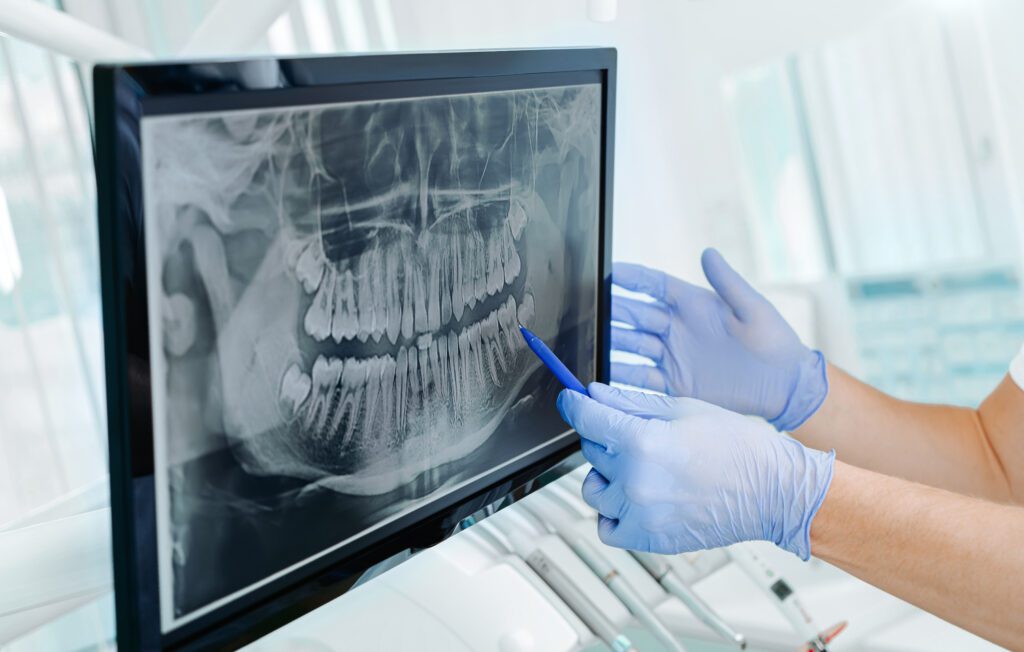 digital X-rays